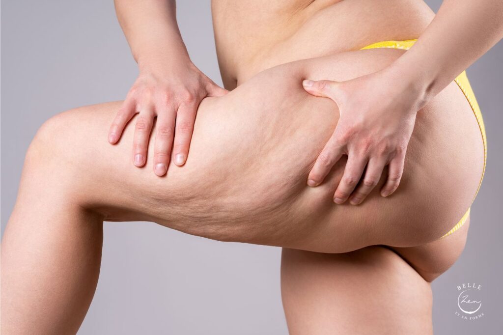 Sais-tu différencier les 3 types de cellulite ?